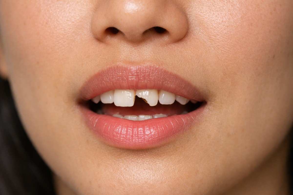 Chipped Tooth: Temporary Fixes vs. Permanent Solutions