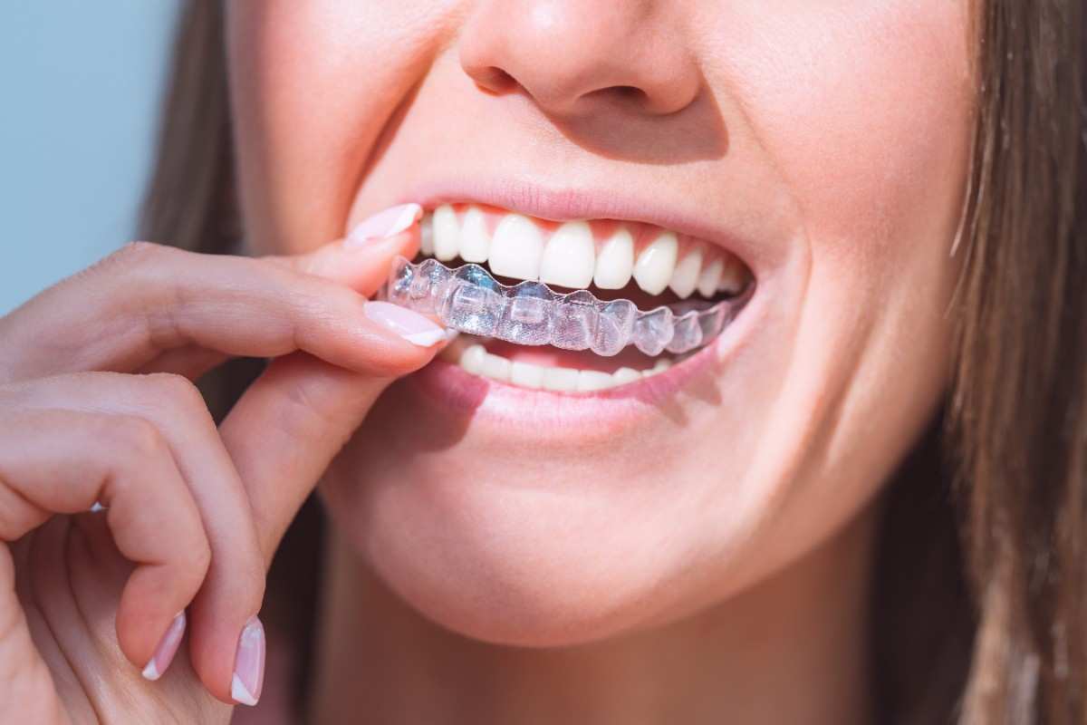 From Consultation to Results: The Invisalign Journey in 2026