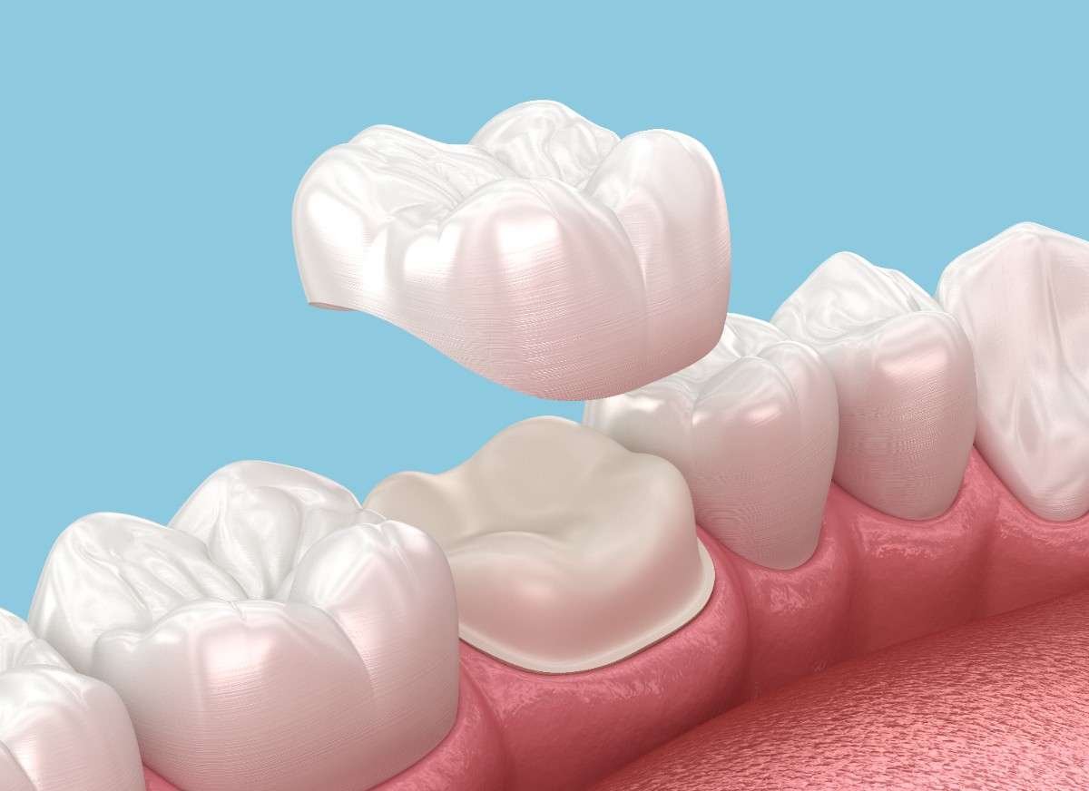 Cracked Tooth? A Porcelain Crown May Be the Solution